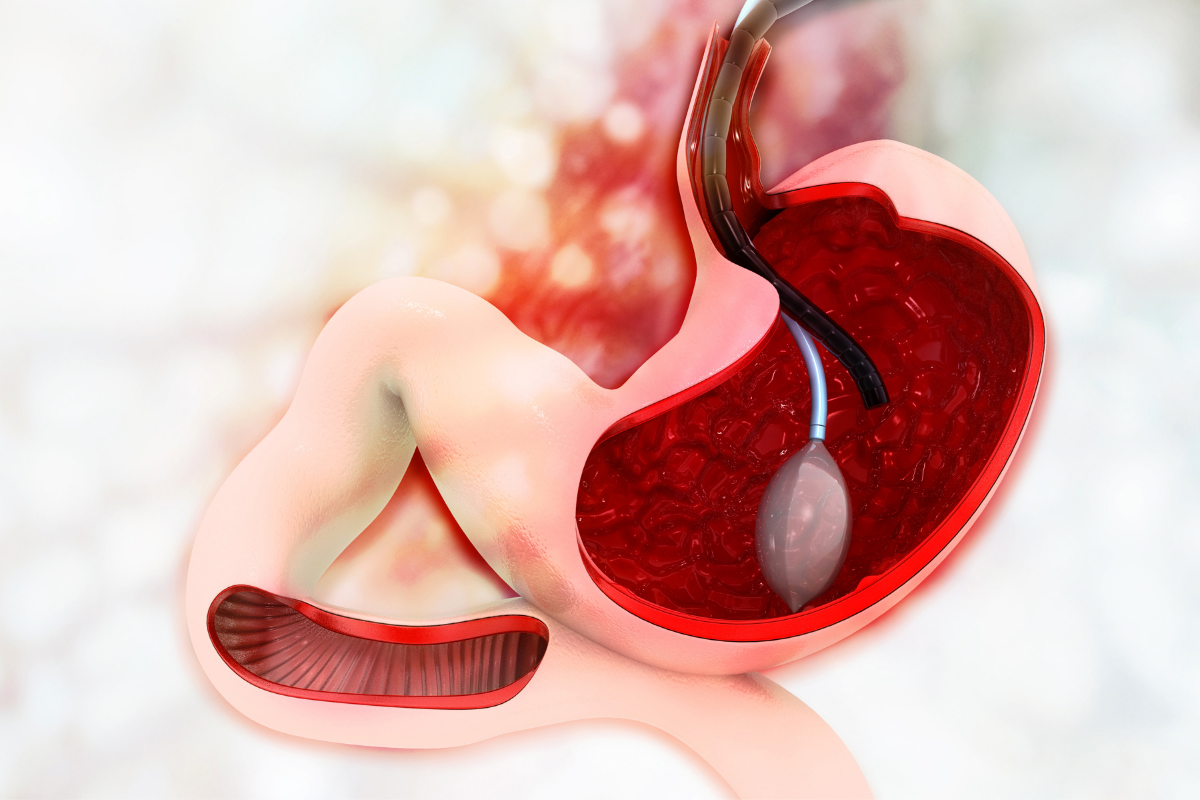Gastric Balloon in Panama: Is It the Right Option for You?